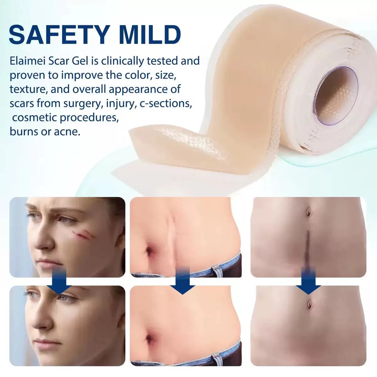 Silicone Scar Repair Tape – C-Section, Surgery & Burn Scar Treatment